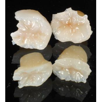 Natural Looking Dental E-Max Glass Ceramic Onlay Inlay